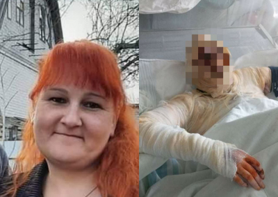 На Кіровоградщині обгоріла жінка потребує допомоги